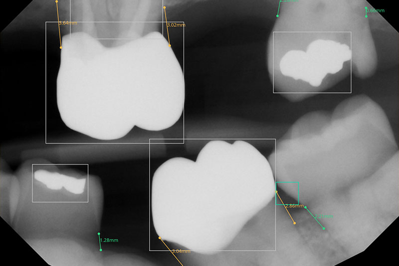 Digital X-Rays in 