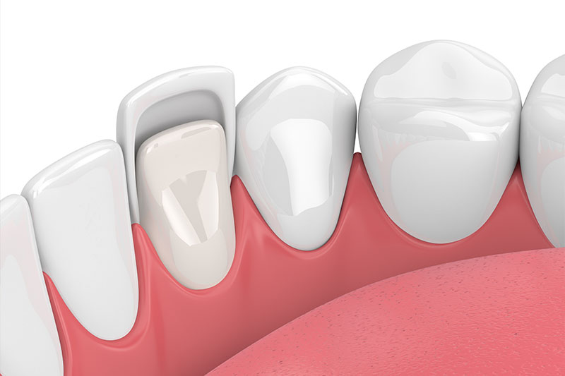 Veneers in Exton
