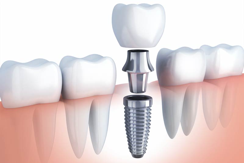 Implants Dentist in Exton