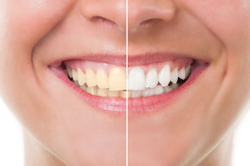 Teeth Whitening in Exton