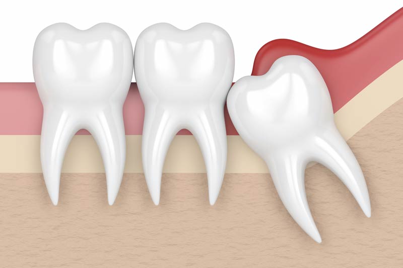 Wisdom Tooth Removal in Exton